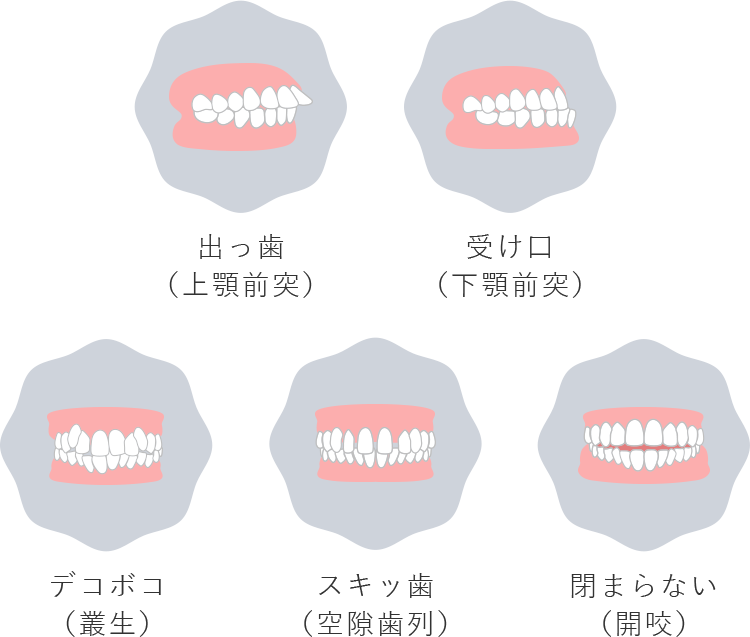 出っ歯（上顎前突） 受け口（下顎前突） デコボコ（叢生） スキッ歯（空隙歯列） 閉まらない（開咬）