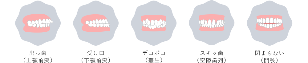 出っ歯（上顎前突） 受け口（下顎前突） デコボコ（叢生） スキッ歯（空隙歯列） 閉まらない（開咬）
